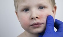 Českem se šíří pátá dětská nemoc. Jak ji poznáte a jak škodí dospělým? 