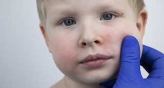 Českem se šíří pátá dětská nemoc. Jak ji poznáte a jak škodí dospělým? 