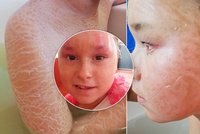 Nela (10) zarůstá kůží, ohrožuje její zrak i sluch: Náročná péče stojí 18 tisíc měsíčně