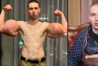 Ruský „Pepek námořník" s napíchanými bicepsy podstoupil další zákrok: Chce vypadat jako mimozemšťan!