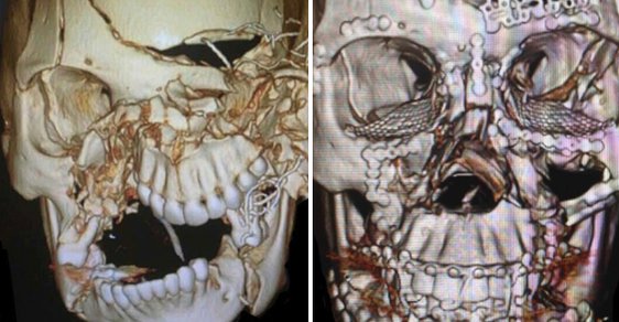 Lebka 25leté ženy vlevo na snímku ukazuje, jak vypadala po nehodě, vpravo pak zrekonstruovaný obličej po precizním zákroku lékařů. 