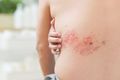 Mýty o pásovém oparu: Proč ho nechytíte od dítěte s neštovicemi?