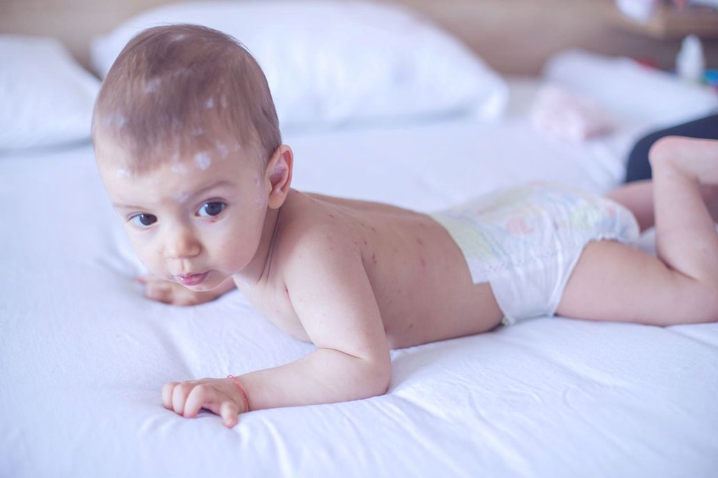 Navzdory mýtům neštovice mohou dostat i kojené děti