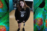 Dáša (17) přišla kvůli nádoru o nohu: Aby si mohla splnit sny, potřebuje bionickou protézu