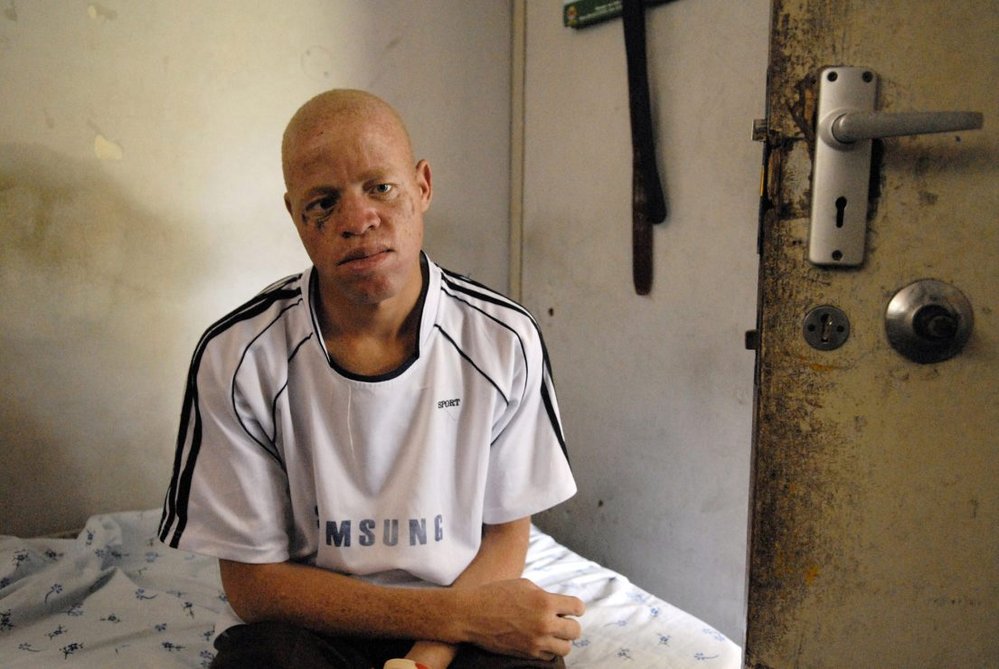 V Tanzanii bohužel dochází k brutálním vraždám, při nichž útočníci usekávají albínům ruce, nohy, genitálie nebo vydloubávají oči. Oběti jsou pak buď mrtvé nebo umírající ponechány osudu, zatímco části jejich těl putují k falešným šamanům. 