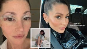 Tereza Kerndlová otevřeně: Snímky před a po plastice