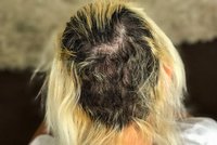Nejhorší prodloužení vlasů, jaké jste kdy viděli: Kvůli nekvalitnímu lepidlu má teď dívka plešku