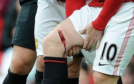 Rooney si drží poraněné stehno. Z otevřené rány crčí krev.