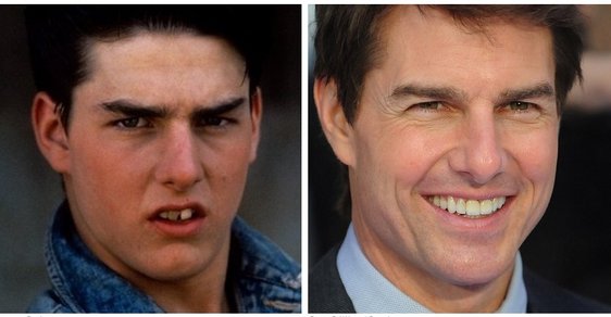 Před a po: Zdravé a bílé zuby dělají člověka krásnějším