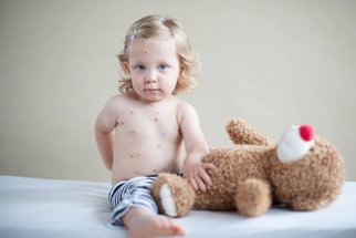 Velký přehled nemocí s vyrážkou u dětí: Jak poznat neštovice, ekzémy nebo smrtelnou meningitidu?